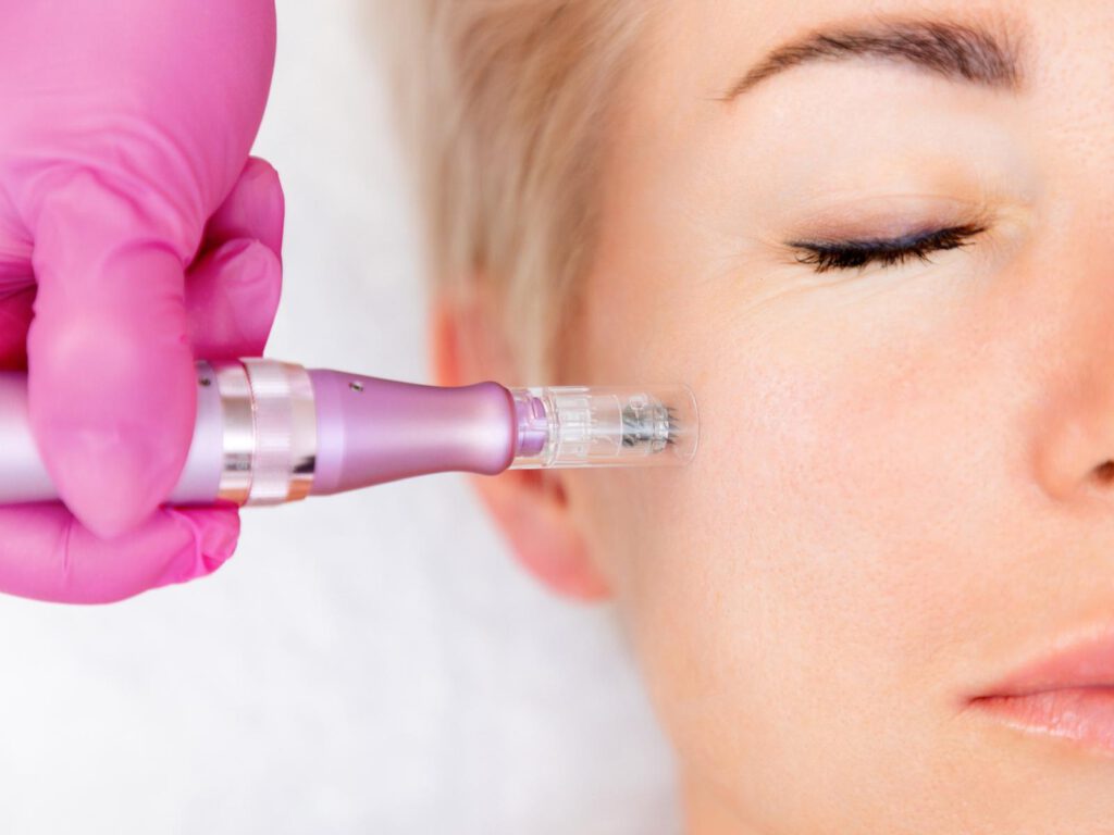 Microneedling Behandlung zur Hautstraffung im Kosmeetikinstiut Vitalraum in Lörrach nahe Basel