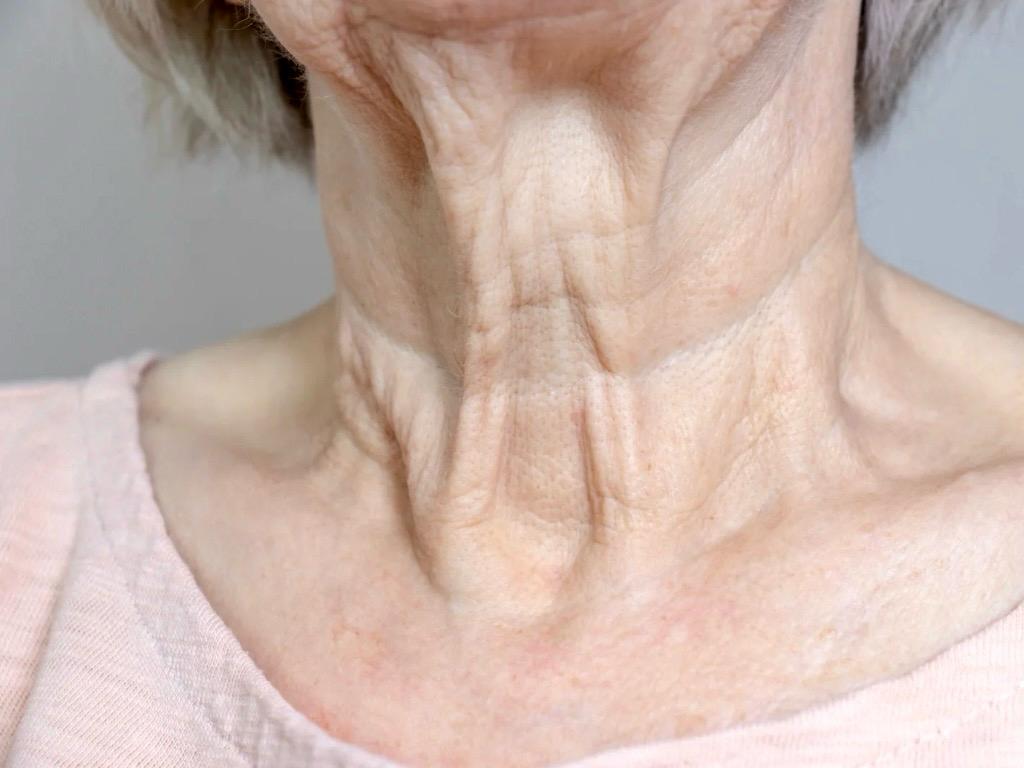 Halsstraffung ohne OP: Erfahre, was wirklich gegen Halsfalten hilft, und wie moderne Hautbehandlungen die Haut am Hals sichtbar straffen können - im Kosmetiksalon Vitalraum Lörrach, nähe Basel